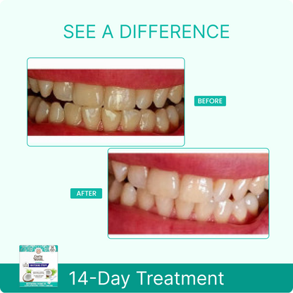 14 Day Whitening Strips